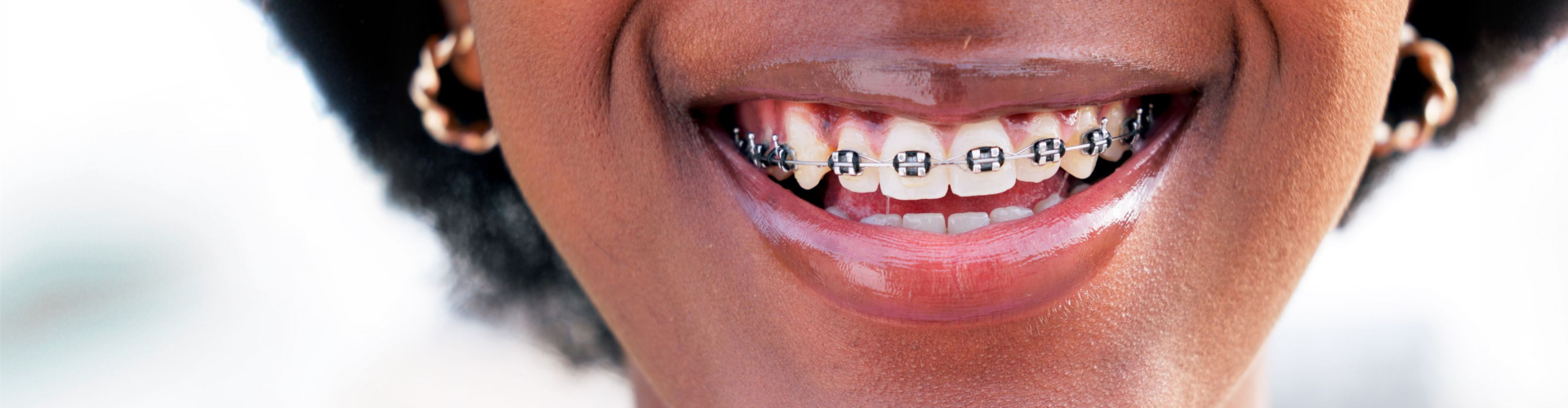 Close up of a person smiling with traditional metal dental braces on their teeth.